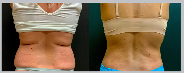 Liposuction