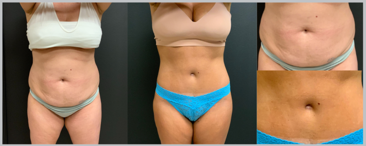 Untitled (Banner (Landscape)) (728 × 90 px) - Breast Aug - Lipo Flanks and Back - Abdominoplasty - Belly Button Scar Close Up