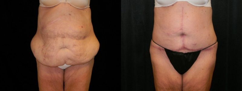 Body Contouring
