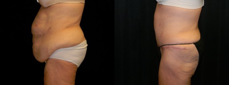 Body Contouring