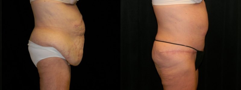 Body Contouring