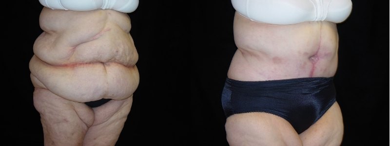 Body Contouring