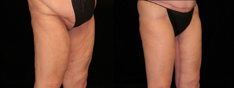 Body Contouring