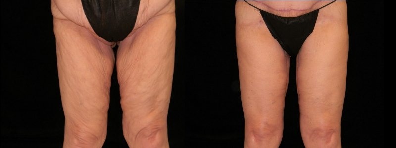Body Contouring