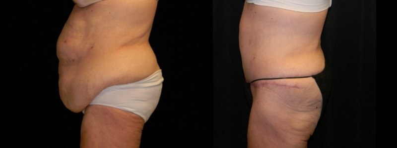 Body Contouring