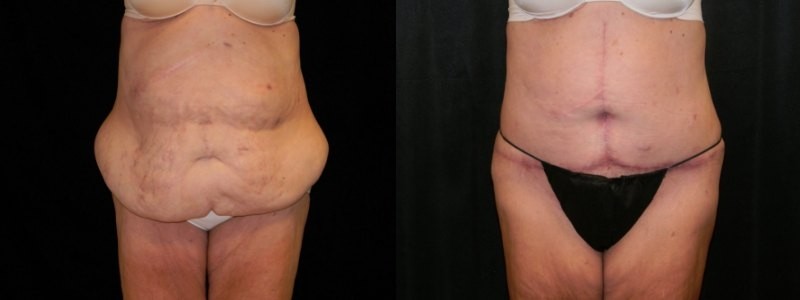 Body Contouring