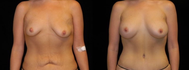 Body Contouring