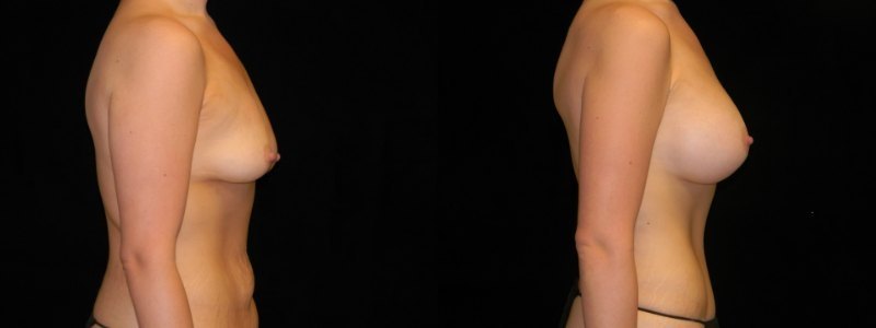 Body Contouring