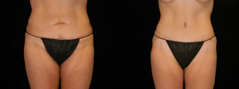 Body Contouring
