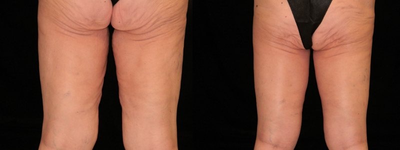 Body Contouring - leg skin removal