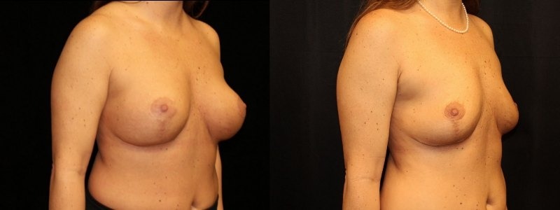 Revision of Breast Augmentation