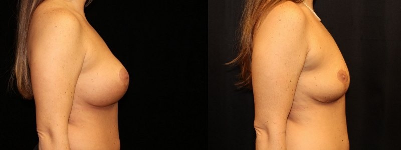 Revision of Breast Augmentation