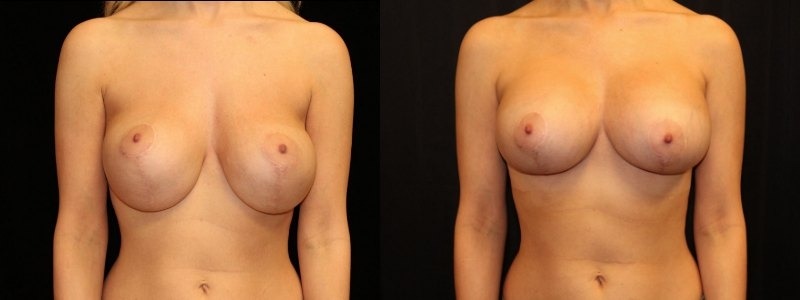 Revision of Breast Augmentation
