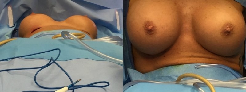 Revision of Breast Augmentation
