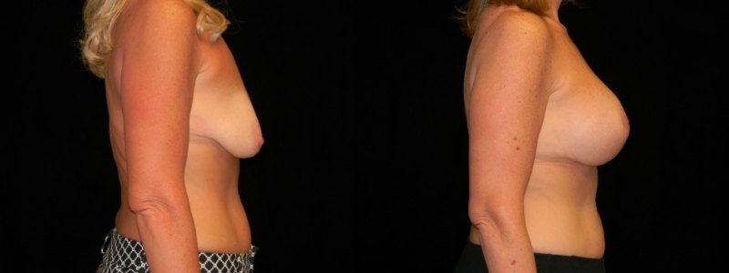 Breast Augmentation with Lift