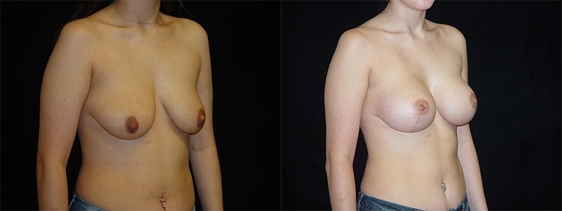 Breast Augmentation with Lift