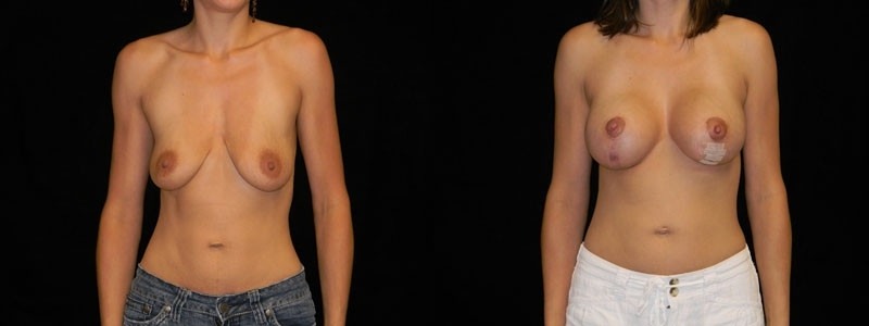 Breast Augmentation with Lift