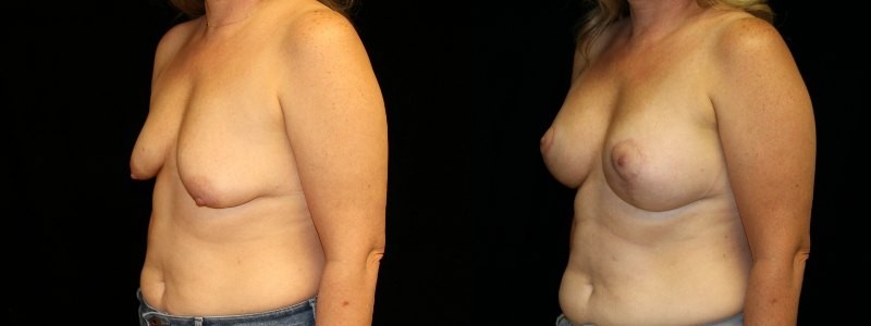 Breast augmentation with lift