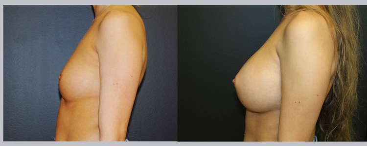 Breast Augmentation