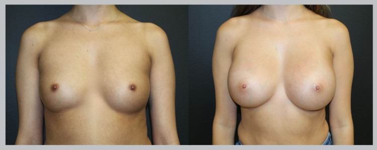 Breast Augmentation