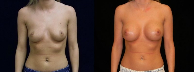 Breast Augmentation
