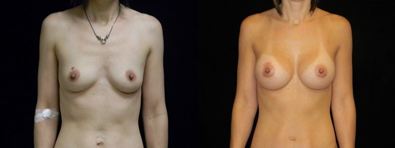 Breast Augmentation