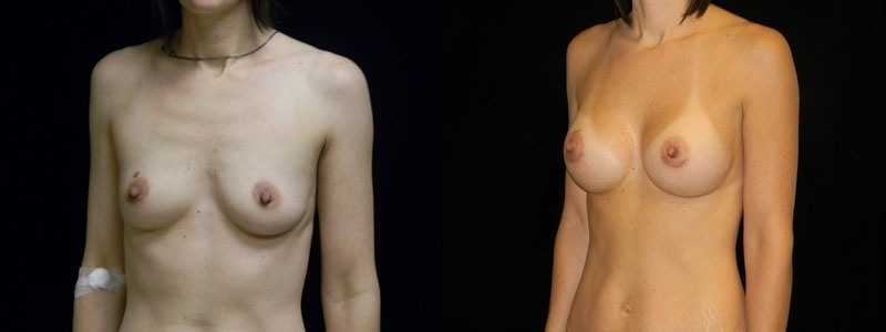 Breast Augmentation