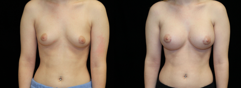 Breast Augmentation