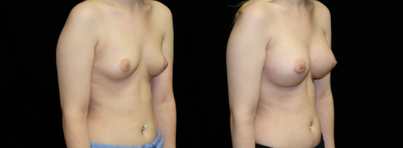 Breast Augmentation