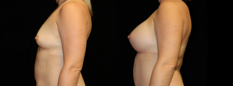 Breast Augmentation