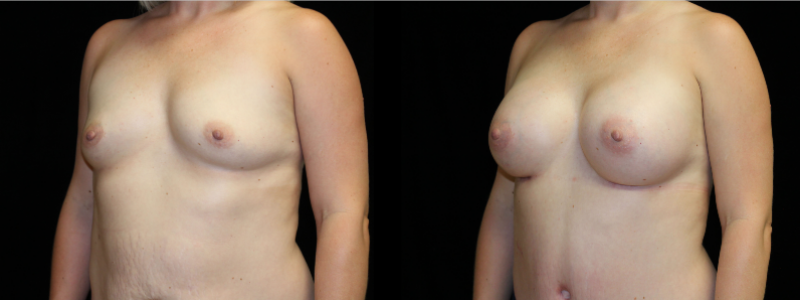 Breast Augmentation