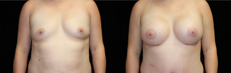 Breast Augmentation