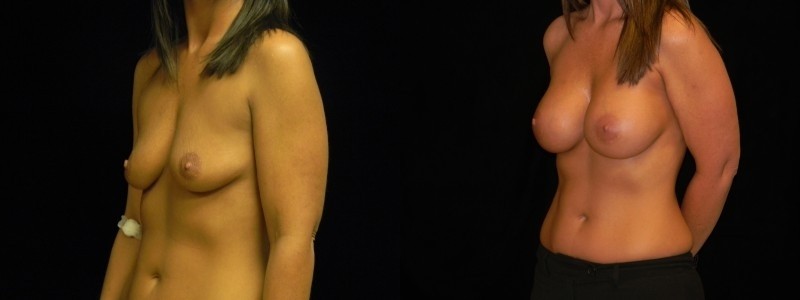 Breast Augmentation