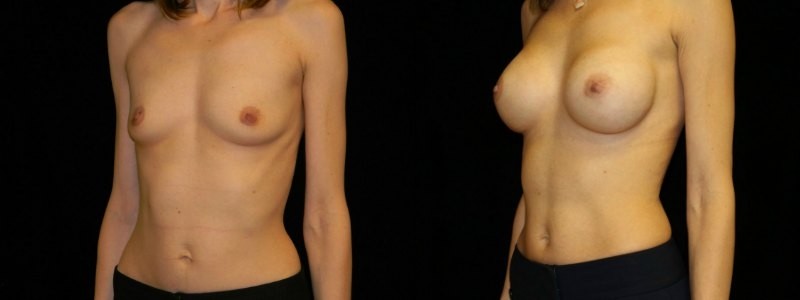 Breast Augmentation