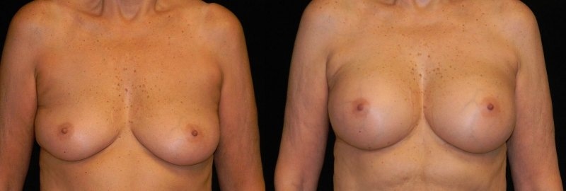 Breast Augmentation