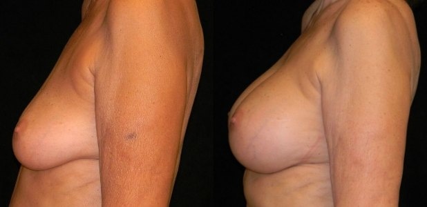 Breast Augmentation