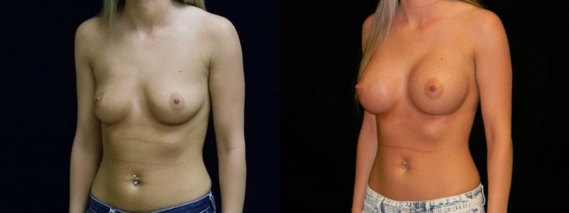 Breast Augmentation