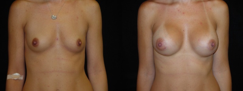 Breast Augmentation