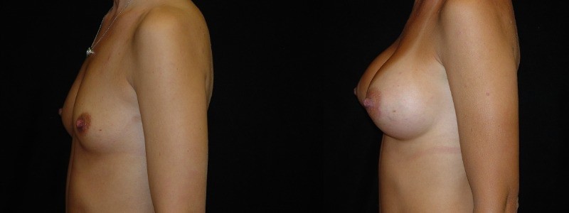 Breast Augmentation