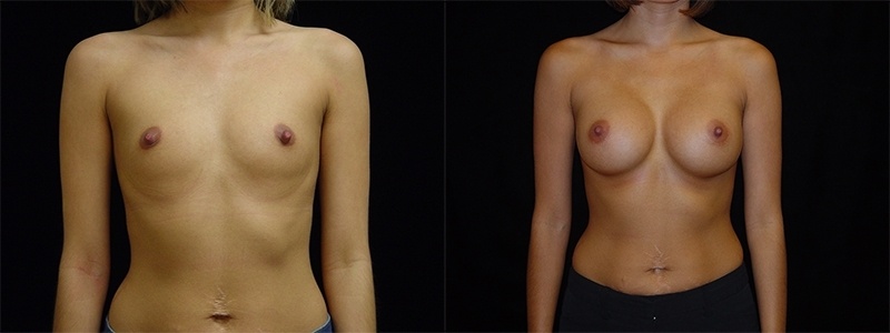 Breast Augmentation