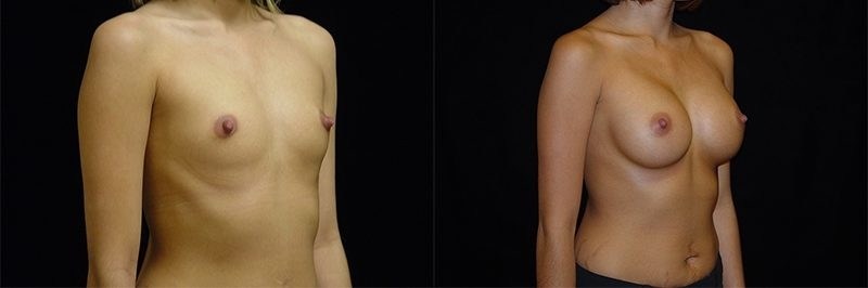 Breast Augmentation
