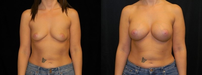 Breast Augmentation