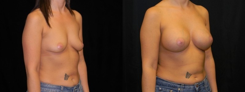 Breast Augmentation