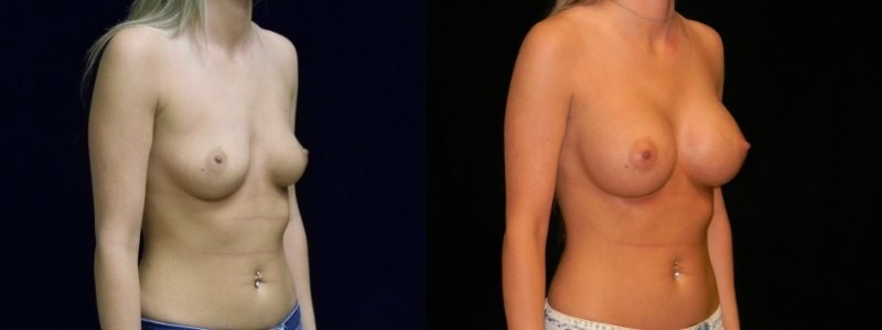 Breast Augmentation