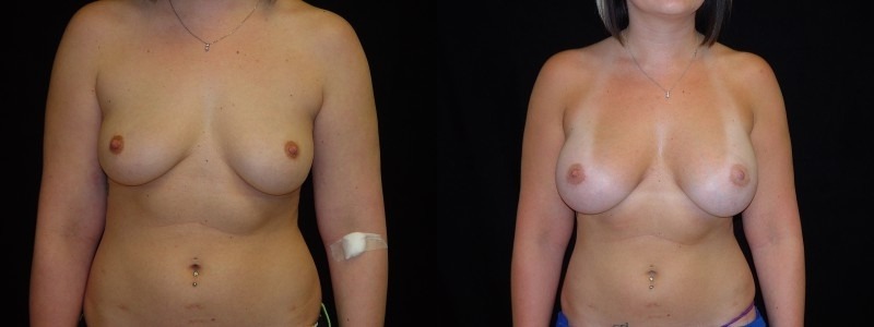 Breast Augmentation