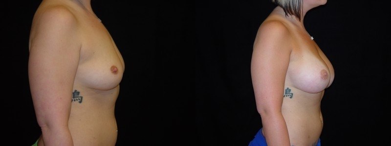 Breast Augmentation
