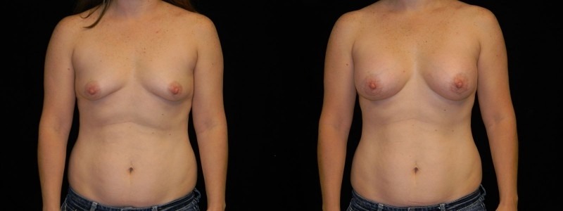 Breast Augmentation