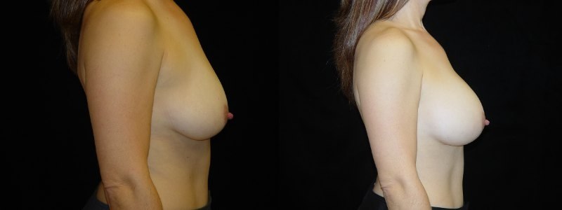 Breast Augmentation