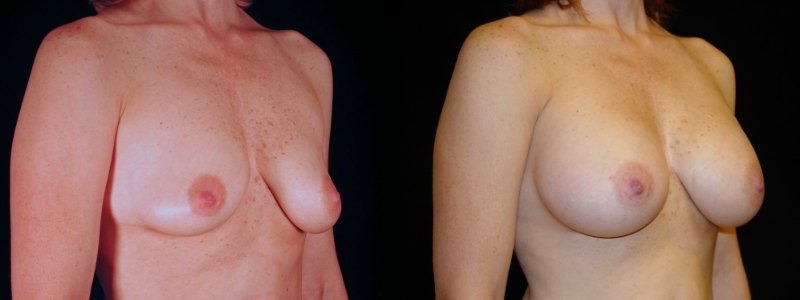 Breast Augmentation