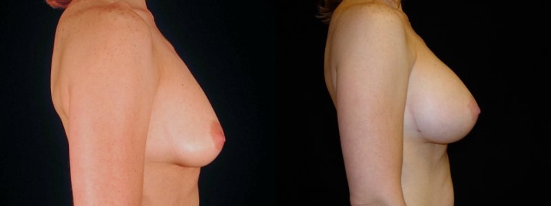 Breast Augmentation